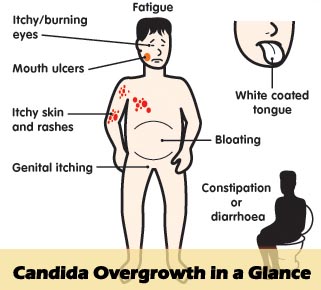 Candida Overgrowth Symptoms | Candida Overgrowth Symptoms in Male | Candida Overgrowth Symptoms in Female | Candida Albicans Overgrowth Symptoms | Intestinal Candida Overgrowth Symptoms
